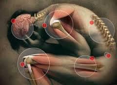 سندرم درد میوفاسیال (Myofascial Pain Syndrome یا MPS)