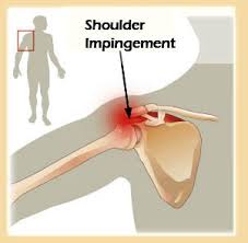 آسیب تاندونی روتاتور کاف یا گیرافتادگی شانه (Shoulder Impingement)