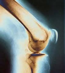 آرتروز زانو (Knee Osteoarthritis)