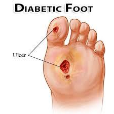 زخم پای دیابتی یا زخم نوروپاتیک (Neuropathic Ulcer or Diabetic Foot Ulcer)