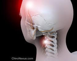 سردرد ناشی از بیماری گردن (Cervicogenic Headache)