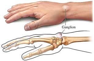 گانگلیون یا توده دست و مچ دست (Hand and Wrist Ganglia)