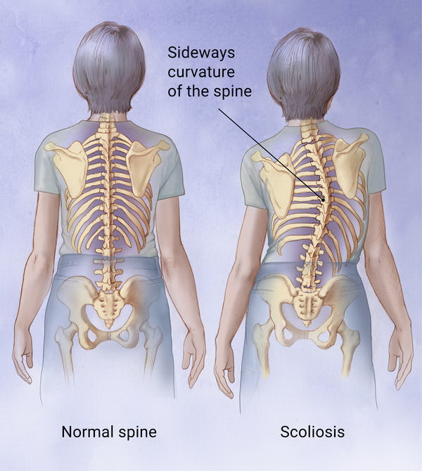 اسکولیوز  (Scoliosis)