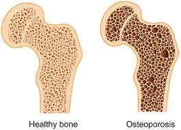 پوکی استخوان یا استئوپروز (Osteoporosis)
