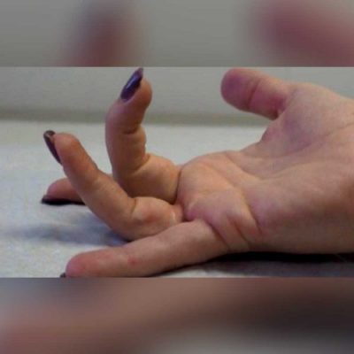 انگشت ماشه ای یا قفل شده (Trigger Finger) - 2